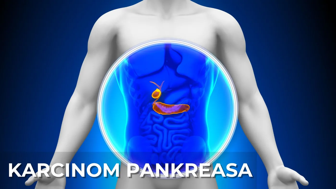 Karcinom pankreasa