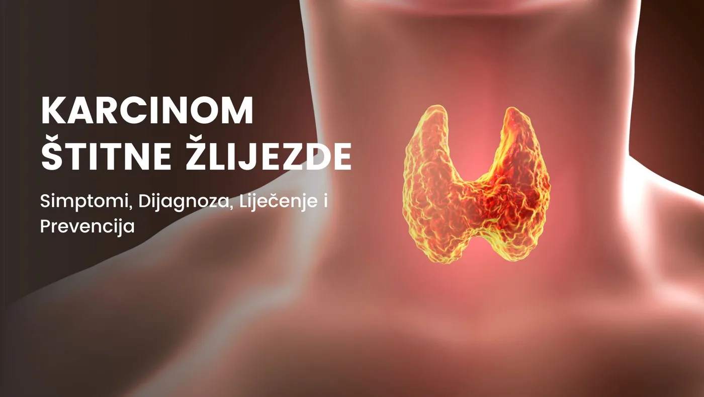 Karcinom štitne žlijezde: Simptomi, Dijagnoza, Liječenje i Prevencija