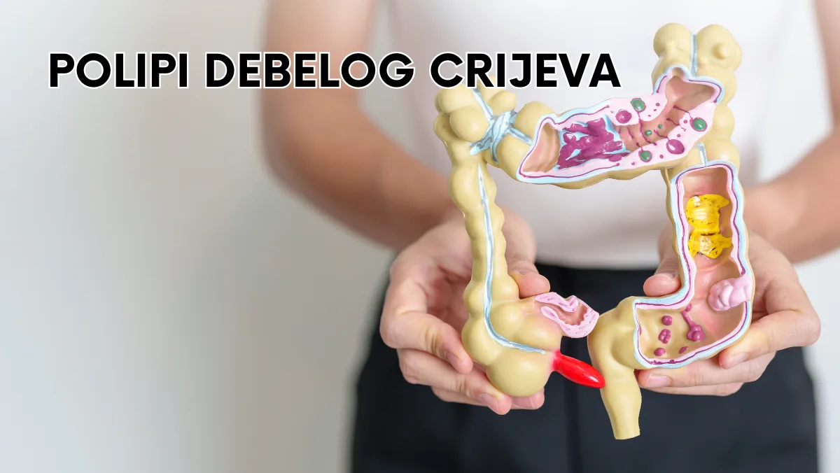 Polipi debelog crijeva