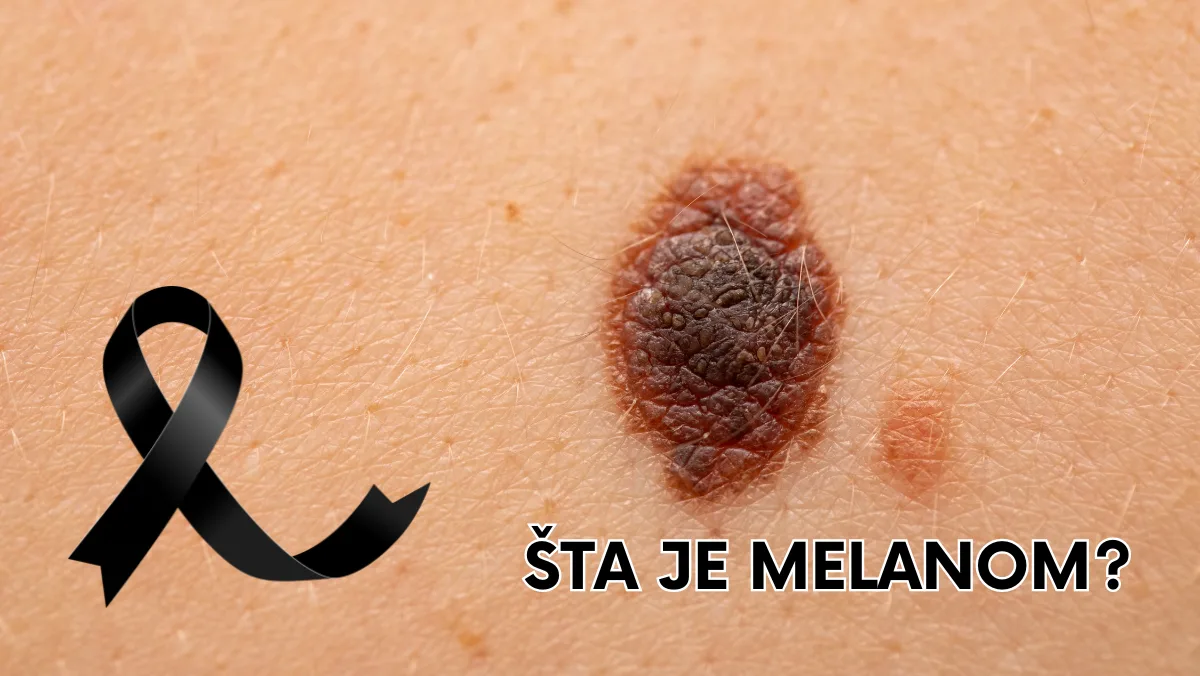 Šta je melanom?