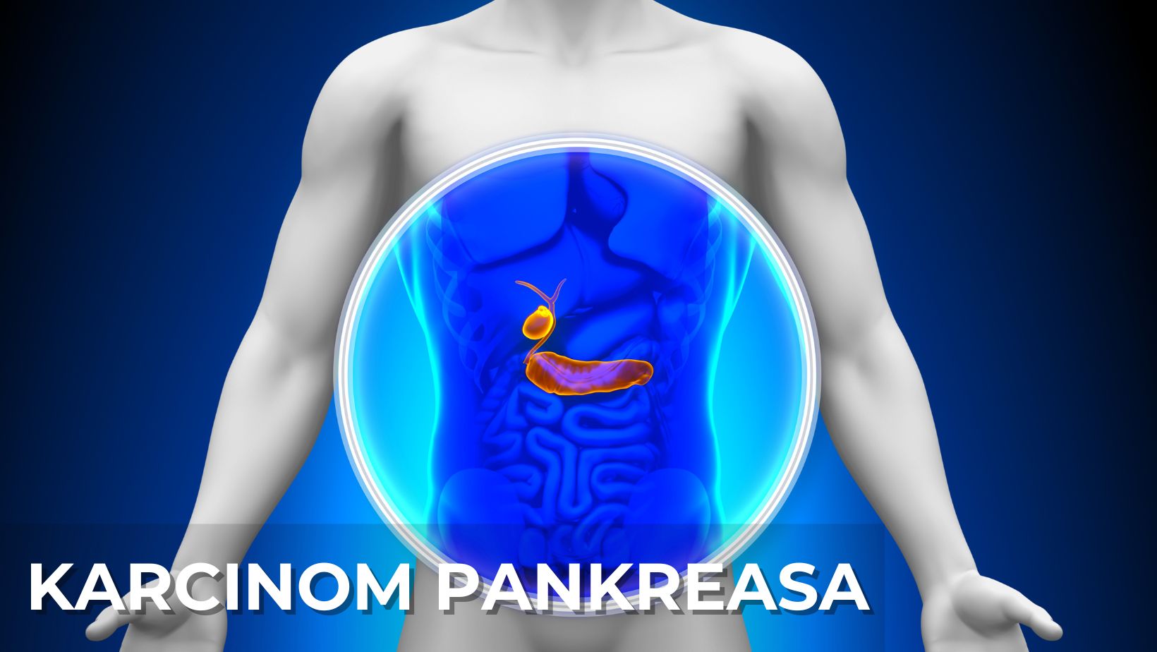 karcinom pankreasa